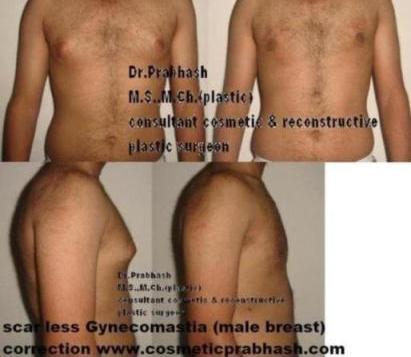 Before After Picture,Male Breast reduction,Gynecomastia Surgery,Delhi