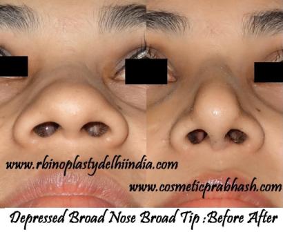 Best Rhinoplasty in India Augmentation Nose Slimming before after Delhi