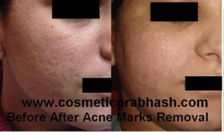 Dermabrasion Delhi NCR Acne Scar Treatment India