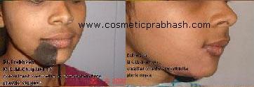 Birthmarks Face Mole Removal Before After Delhi Dr Prabhash India