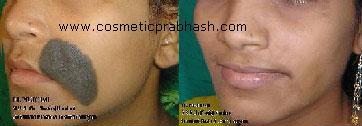 Face Hairy Mole Removal Delhi Nevus Removal india Dr Prabhash