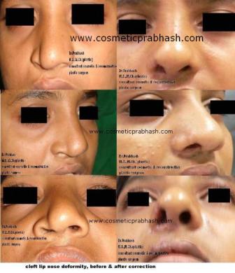 Rhinoplasty in India - Delhi - cleft nose rhinoplasty before after dr prabhash.