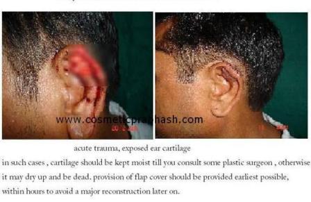 Plastic Ear Surgery Delhi Ear Reconstruction India