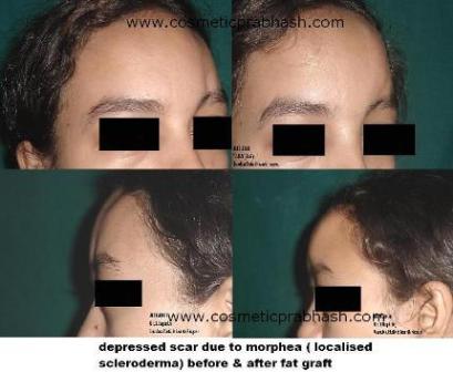 Forehead Depression Fat Injection Morphea, Delhi, India.