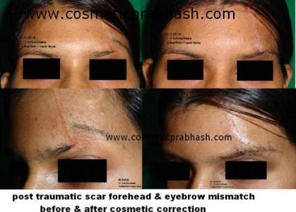 Eyebrow Scar Removal Treatment Delhi NCR India
