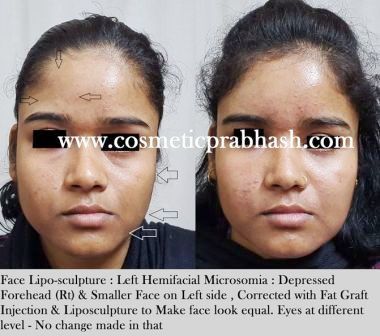 Face fat grafting Before After face liposculpture delhi, india.