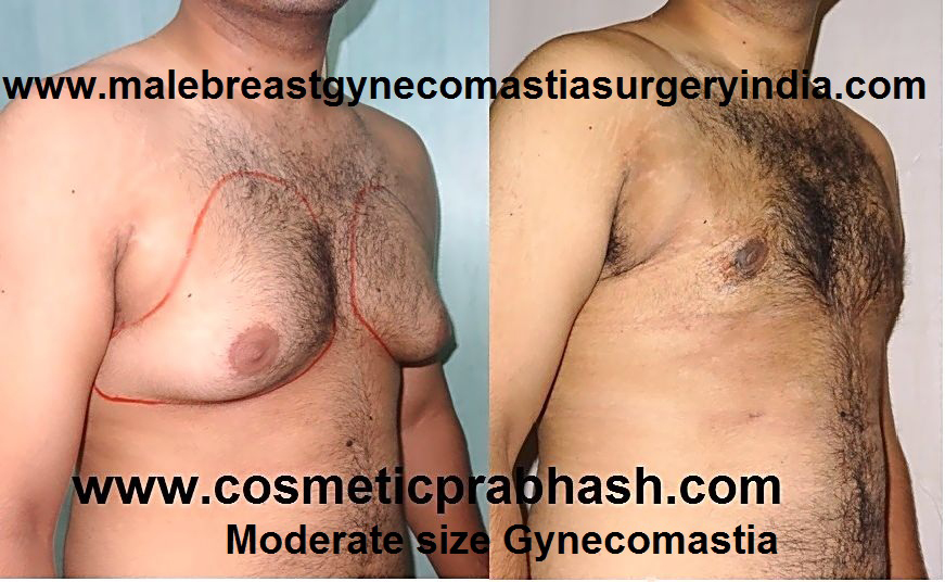Gynecomastia Treatment Before after Grade 2 India Dr Prabhash Delhi