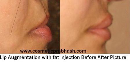 Lip Augmentation Delhi Lip Fat Injection India