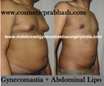 gynecomastia surgery delhi male chest fat & abdomen fat liposuction india