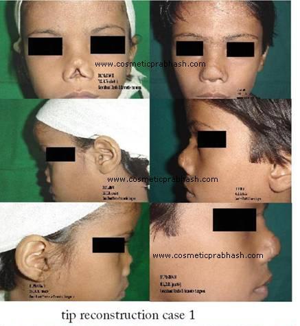 Nose reconstruction with fore head flap