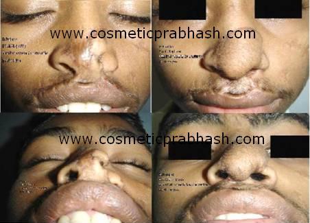 Lip Nose Deformity - Lip Nose Reconstruction Before after picture (Delhi, India)