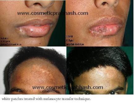 White patch leucoderma removal before after Delhi Dr Prabhash India