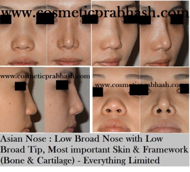 rhinoplasty in India asian nose  before after Dr Prabhash Delhi