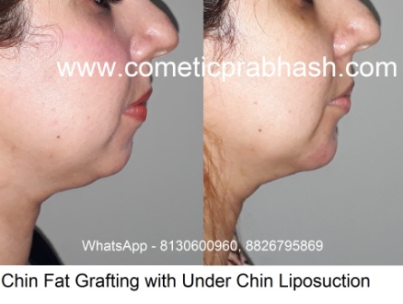 Chin enlargement India chin fat grafting Delhi 2
