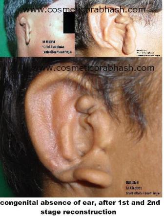 Ear Reconstruction cartilage Delhi Dr Prabhash India