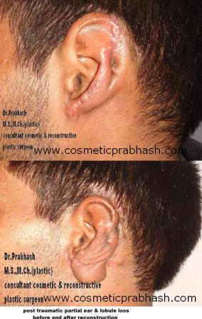 Cartilage Frame Ear Reconstruction Surgery Delhi Dr Prabhash India