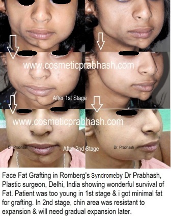 Face fat grafting Before After in Romberg's Disease by Dr Prabhash, Delhi, (India).
