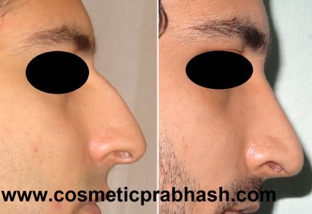 Rhinoplasty in India - Dorsal nose hump removal rhinoplasty before after delhi dr prabhash.