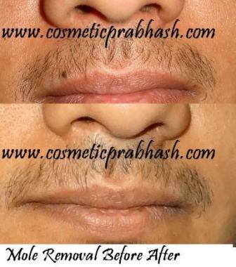 Face Mole Removal Before After Delhi Dr Prabhash India
