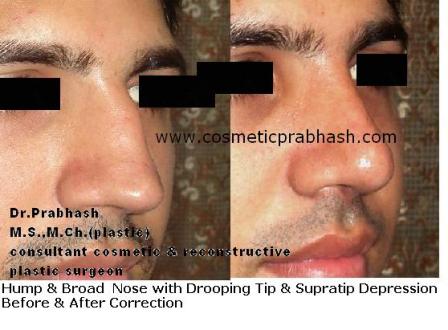 Rhinoplasty in India - Delhi - Nose bone hump reduction rhinoplasty before after dr prabhash.