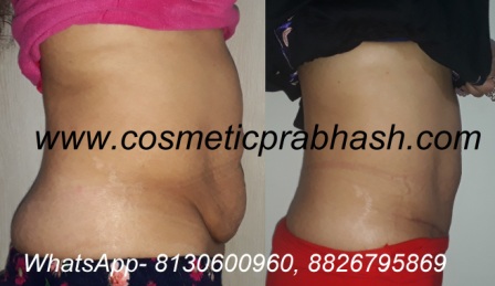 Tummy tuck delhi panniculectomy Abdominoplasty india Dr Prabhash