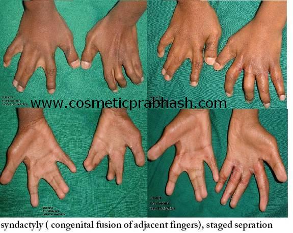 before after, syndactyly, joined fingers