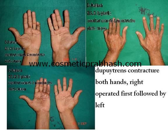 before after, hand surgery, dupuytrens contracture