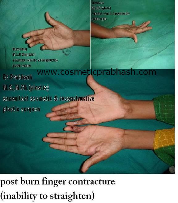 before after, hand surgery, finger contracture