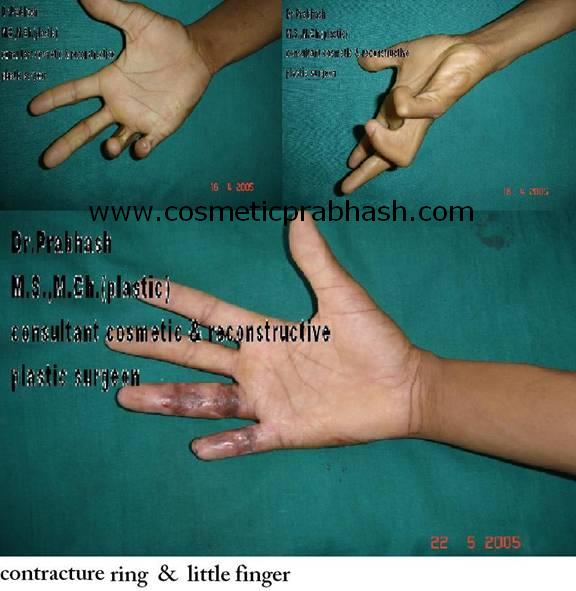 before after, hand surgery, finger contracture