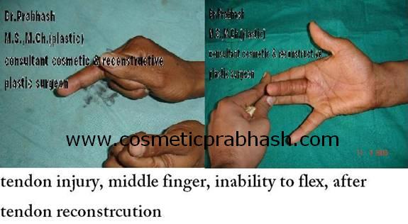 before after, hand surgery,tendon reconstruction