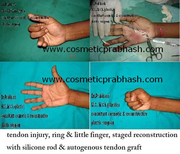 before after, hand surgery,tendon reconstruction