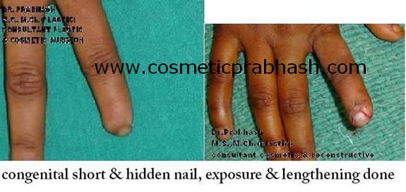 before after, hand surgery,nail lengthening
