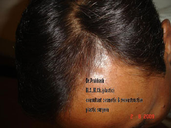 Before After Pictures,Cosmetic & plastic Surgery,Delhi,Hair Transplantation