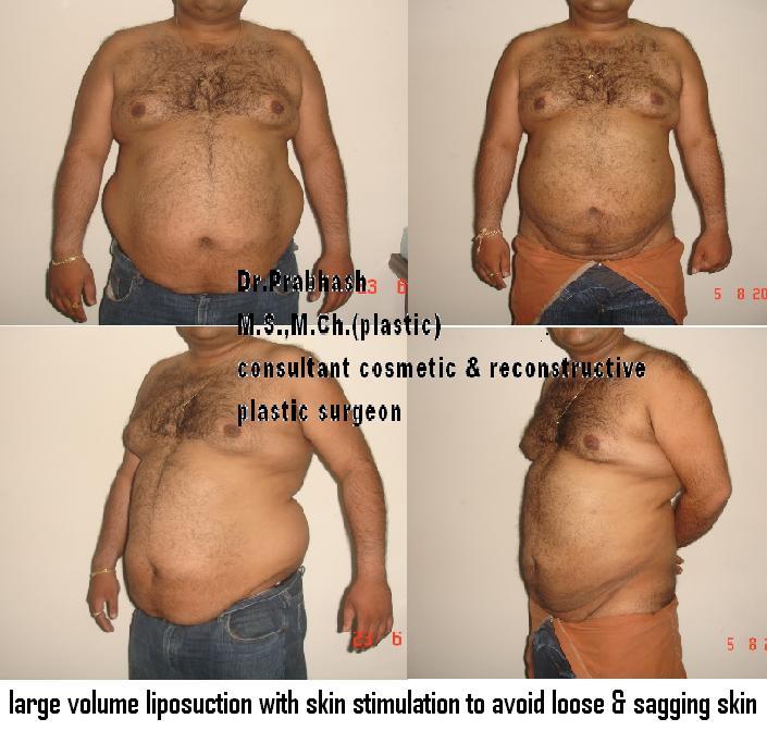 Before After Pictures,Cosmetic surgery,Delhi,Mega Liposuction