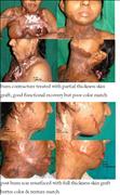 Before After Pictures,Cosmetic surgery,Delhi, Burn Scar,neck contracture