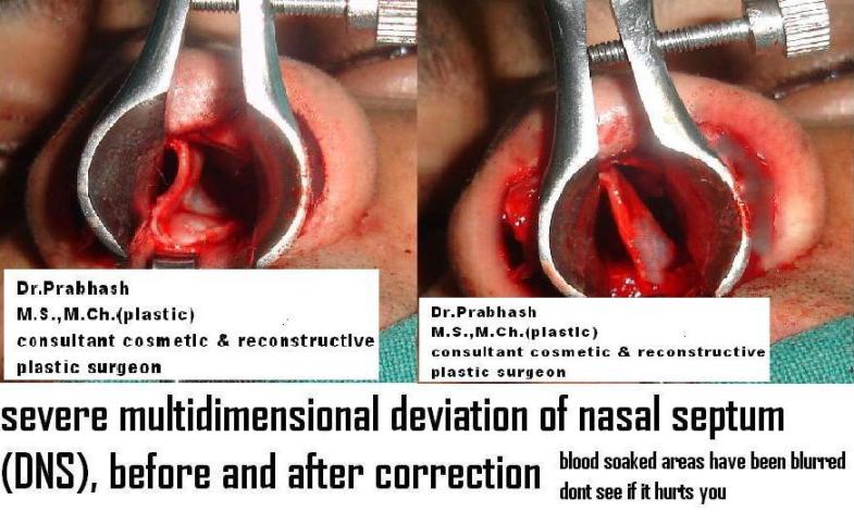 Before After Pictures,Nose job,Rhinoplasty,Delhi, DNS Correction,Septoplasty