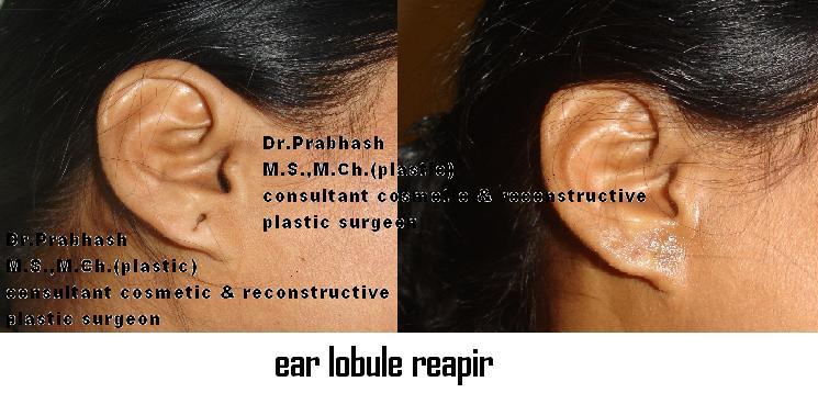 Before After Pictures,Cosmetic surgery,Delhi,Ear Lobe Repair