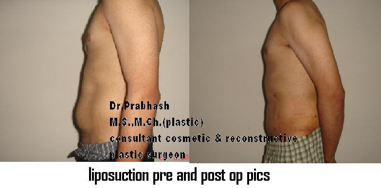 Before After Pictures,Cosmetic surgery,Delhi,Liposuction