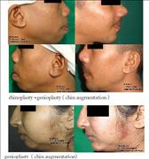 Before After Pictures,Nose job,Rhinoplasty,Delhi,Chin Augmentation, Profiloplasty