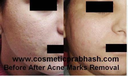 Dermabrasion Delhi NCR Acne Scar Treatment India