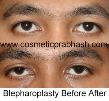 Blepharoplasty Before After Picture in Delhi