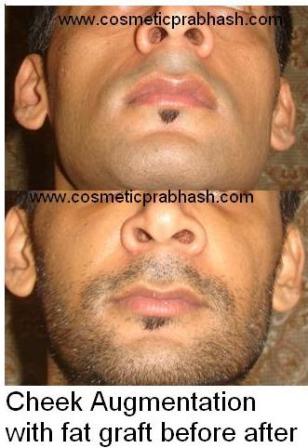 Cheek Lift Augmentation Fat Injection Delhi, India.