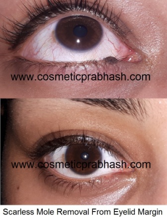 Mole Removal from Eyelid Margin by Dr Prabhash, Delhi, India.