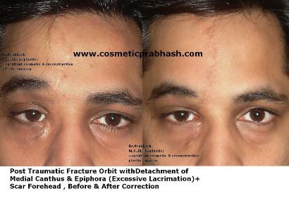 Eyelid Surgery Canthoplasty Eyebrow Scar correction before after in Delhi