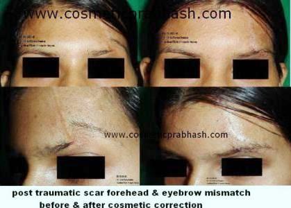 Eyebrow Scar Removal Treatment Delhi NCR India