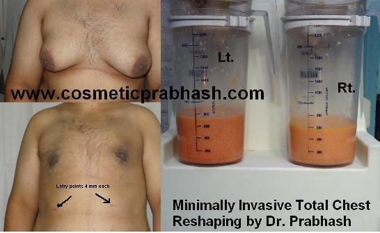 Gynecomastia Surgery Before After India Grade 3 Gynecomastia Delhi