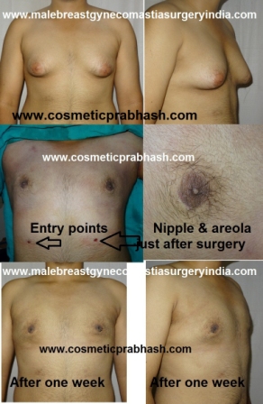 gynecomastia surgery