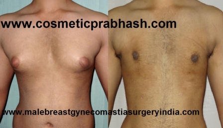 Gynecomastia Treatment Surgery Delhi Best Male Breast Reduction
