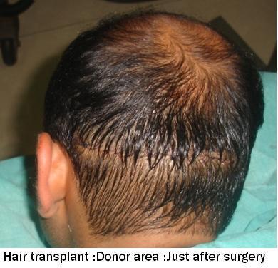 Hair Transplant