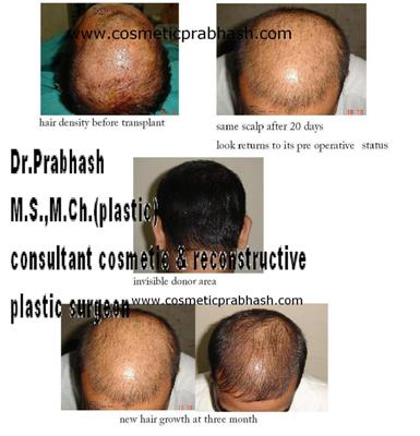 Hair Transplant Procedure & Course
